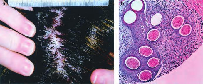 Positive CD3 and CD20 stains indicate predominant B cell lymphoma. Figure 13 Case 13: 44-y-old Hispanic male. Recurrent folliculitis of scalp for 15 y (a, b).