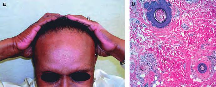 10 : 3 DECEMBER 2005 DERMATOLOGY WORKSHOP, BERLIN 261 Figure 15 Case 15: 72-y-old black female. Receding frontal hairline and thinning eyebrows for 1 y (a, b).