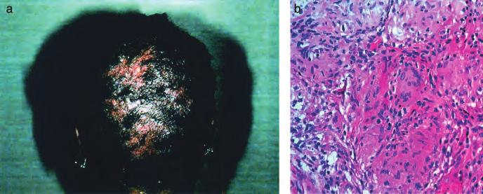 Many follicular units fibrose. May have features of lichen planopilaris. Figure 16 Case 16: 46-y-old black female. Nodules on the scalp, face, and arms with bone pain, 3 y (a, b).