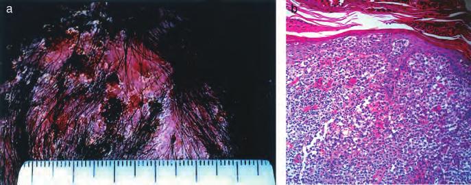 Acid fast and GMS stains negative. Figure 17 Case 17: 40-y-old white female. Itchy, scaly, excoriated, septic scalp, 4 y (a, b).