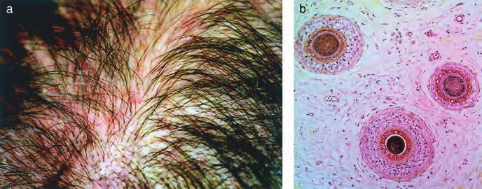 262 WHITING AND HOFFMAN JID SYMPOSIUM PROCEEDINGS Figure 18 Case 18: 27-y-old white male: Patchy scalp hair loss (a, b).