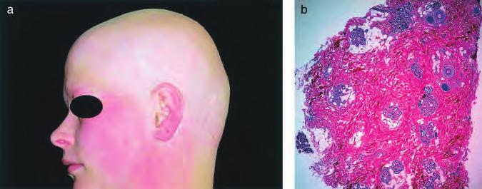 Nonspecific cicatricial alopecia: Lymphocytic infiltrate around the upper and mid-follicle. No interfollicular infiltrate. Loss of sebaceous epithelium. Follicular fusion.