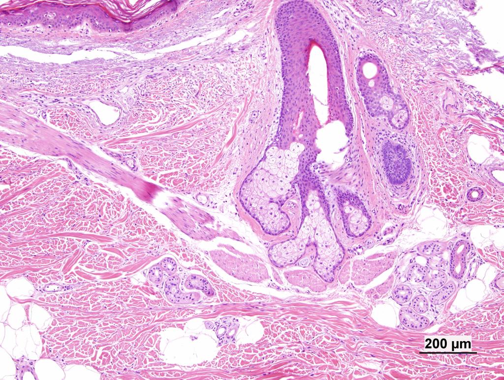 Papillary dermis Hair follicle (note the solar elastosis : not technically normal, but almost