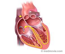 Catheter Ablation A normal heartbeat is controlled by a smooth, constant flow of electricity through the heart.
