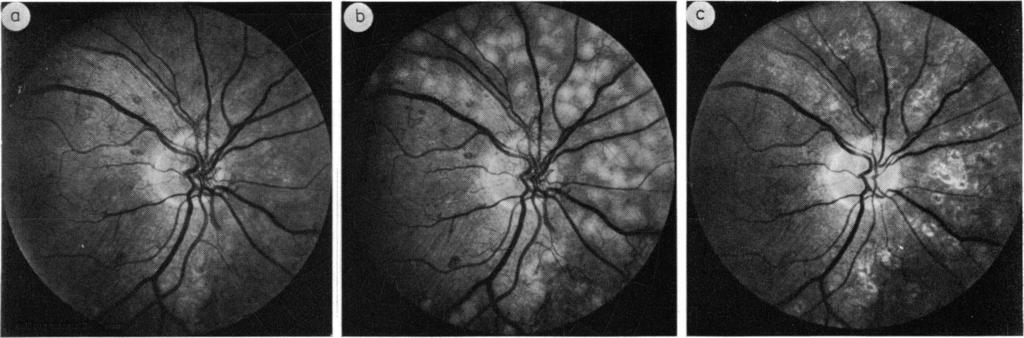 416 Fig. 4 after treatment in an argon-treated eye with complete regression of disc vessels W. E. Schulenburg, A. M. Hamilton, and R. K.