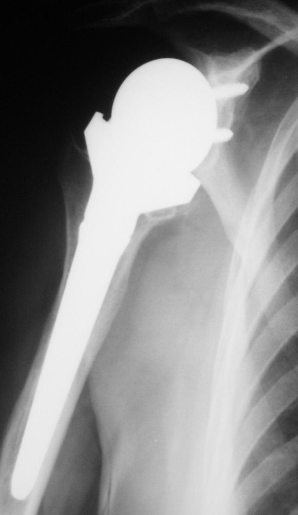 shoulder: Painless notching, stabilized after 12