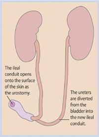 In the operation, the bladder, the prostate, the seminal vesicles (sperm sacs) and, If necessary, the urethra (water pipe) are removed.