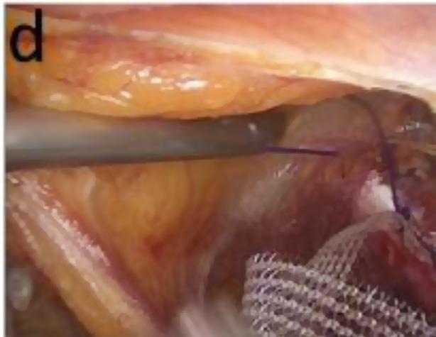 nonabsorbable sutures. The middle of the mesh is fixed at the lower anterior segment of the uterus with three stitches.