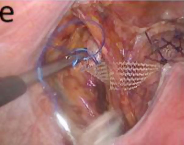 ral parts of the iliopectineal ligament for a bilateral mesh fixation of the descended structures, so fewer potential long-term problems are