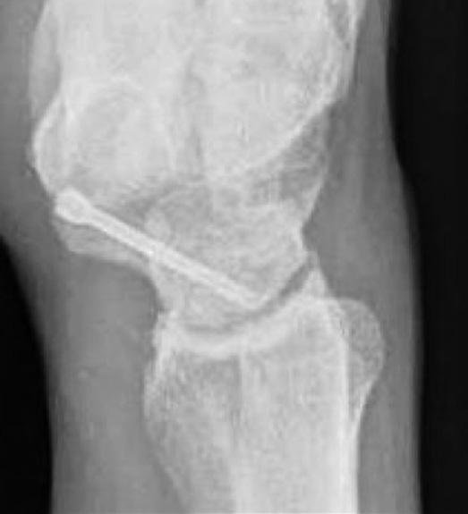 (b) The lateral view, showing no carpal malalignment. K-wire.