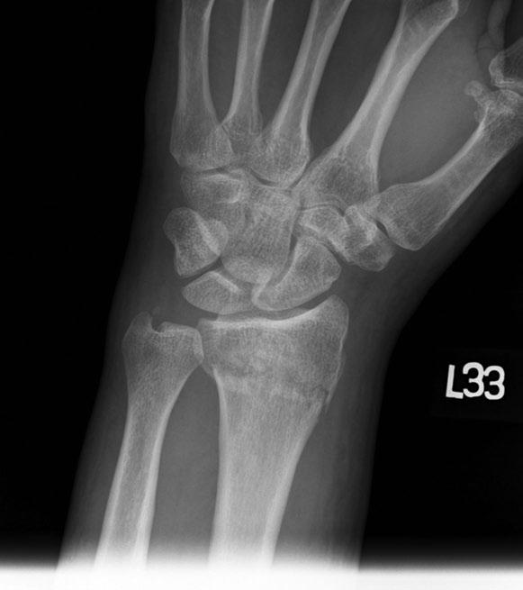 Chapter 1 Figure 1.1 Colles fracture. Note the dorsal angulation of the distal radius as shown in Figure 1.2. (Image courtesy of Carl Germann, MD.