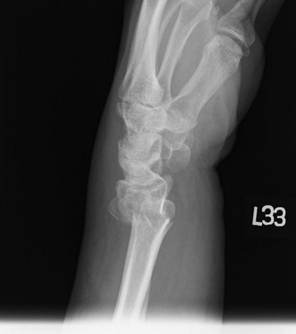Hand and wrist emergencies Figure 1.2 * Smith fracture should undergo closed reduction. Following reduction, patients should be placed in a long-arm splint in supination.