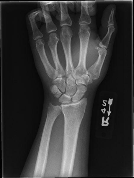 Hand and wrist emergencies Figure 1.6 Scaphoid fracture: An acute non-displaced fracture is shown in anteroposterior view. (Image courtesy of Carl Germann, MD.