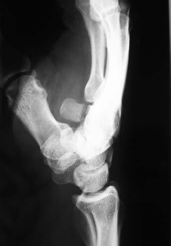 Hamatum fractures Mainly