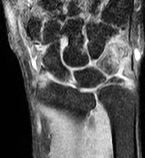 Triquetrum fractures most often dorsal avulsion fracture!