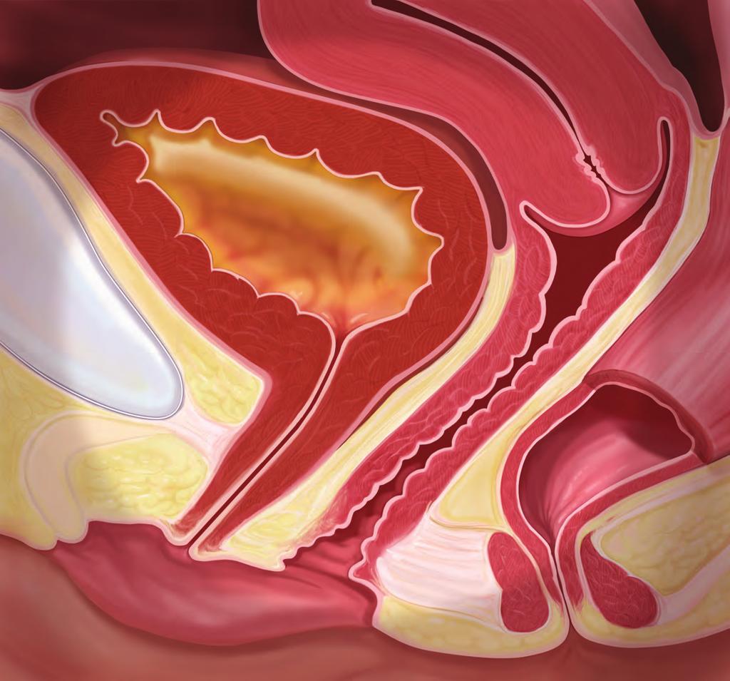 Women affected by pelvic prolapse sometimes refer to their dropped bladder or fallen uterus.