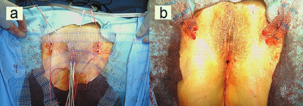 The OABSS changes after repair for cystocele Figure 2 The four-strap mesh (a). The four straps from skin (b).