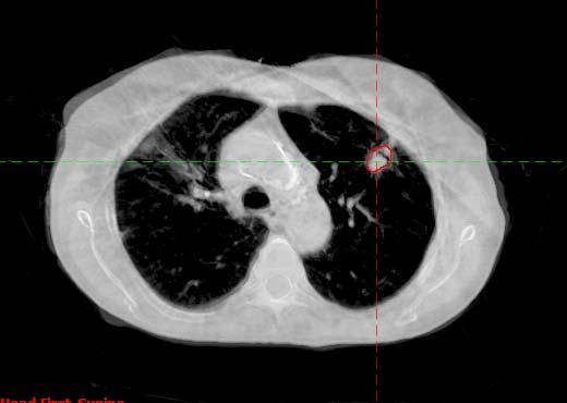Cone Beam CT - Lung