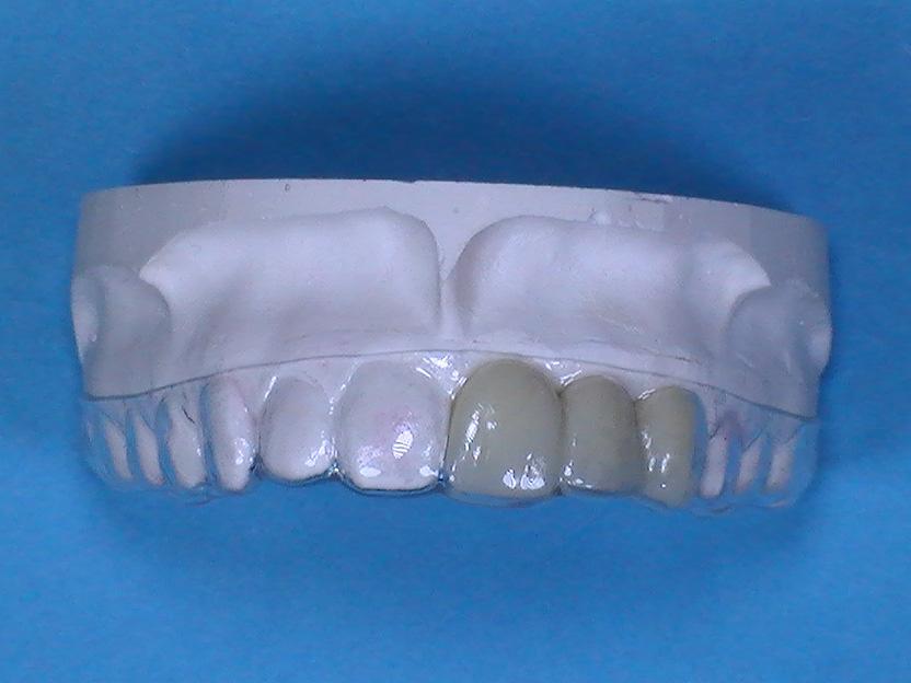 Invisible Retainer with Multi-Tooth Pontic Fabrication Technique (Single-Tooth Pontic Procedure also available)