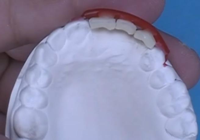 Round sprue wax to facial arch of dentition and pontics. Cut excess wax along tooth crowns.