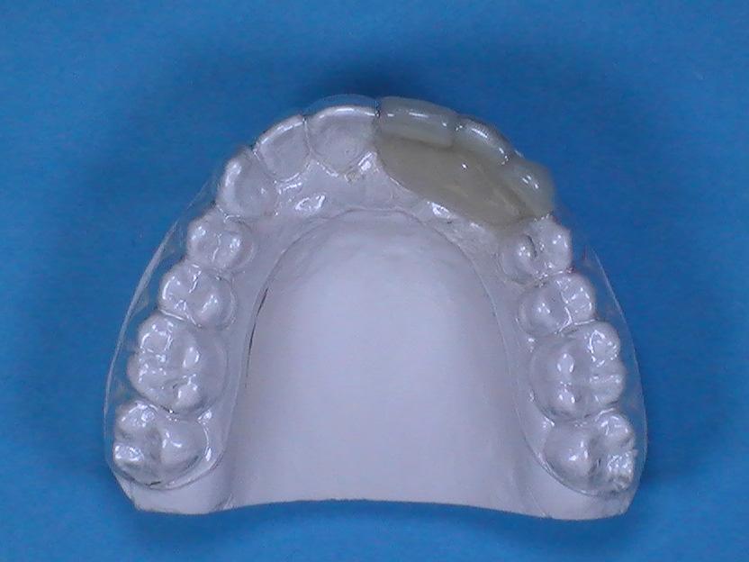 Completed retainer with pontic(s). Items featured in technique: 235-009 Astro Spec Safety Glasses (reg.