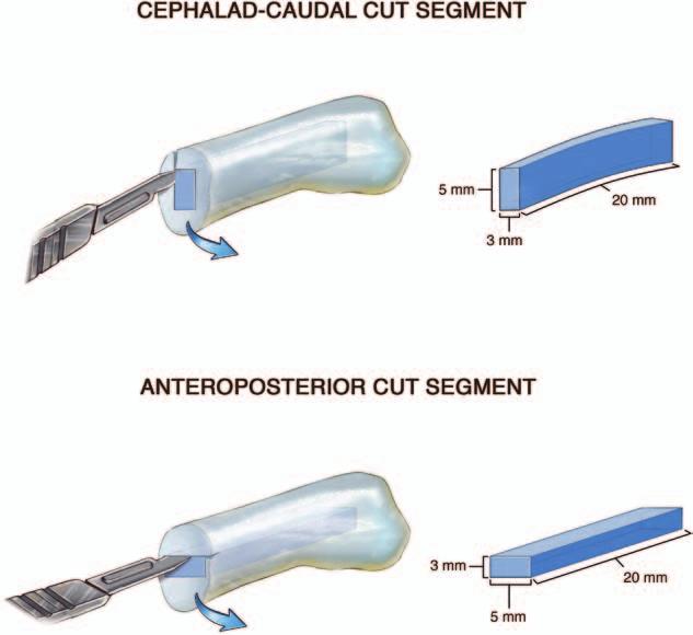 Plastic and Reconstructive Surgery August 2013 and colleagues expanded on the intrinsic interlocked stresses and mechanical characteristics of cartilage to lay the foundation for understanding the