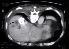 Endoscopic retrograde cholangiography (case 1) failing to demonstrate the bile leak, and
