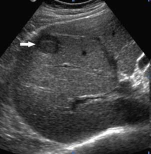 Transrectal Ultrasound