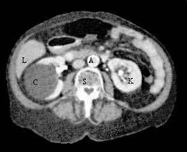 CT Liver