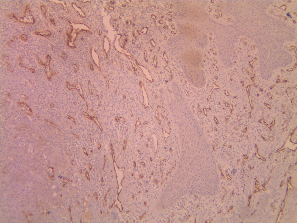 CD68 was detected in some of MCs and endothelial cells (Figure 2,3A,B) of all groups (Table III).