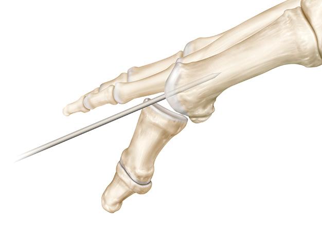 metatarsal head. With the Placer and Guide Pin in the drill, position the Guide Pin perpendicular to the central aspect of the metatarsal head.