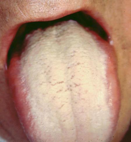 Ayurveda: Ama Signs and symptoms of Ama include: A sticky white coating on the tongue which obstructs various internal microchannels Inability to taste food Local or general inflammation Sudden