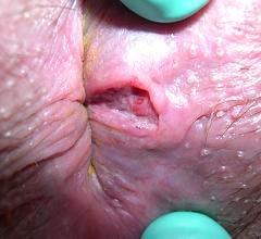Case 44 year old HIV-infected man with new lesion near his anus Slide 22