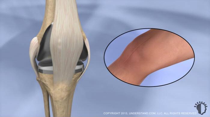 Introduction A total knee replacement, also known as total knee arthroplasty, involves removing damaged portions of the knee, and capping the bony surfaces with man-made prosthetic implants.