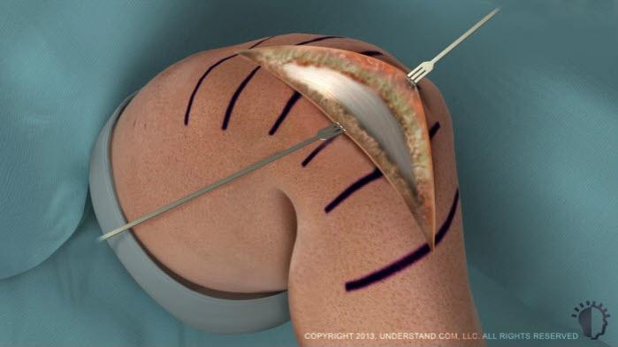 Procedure Accessing the Joint Surfaces Surgical details vary by procedure and component design.