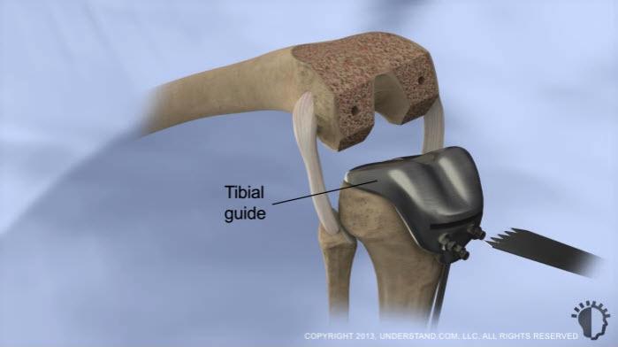 An incision will be made on the midline at the front of your knee; minimally invasive procedures use a four to six inch incision, whereas open procedures, as shown here, traditionally require a seven