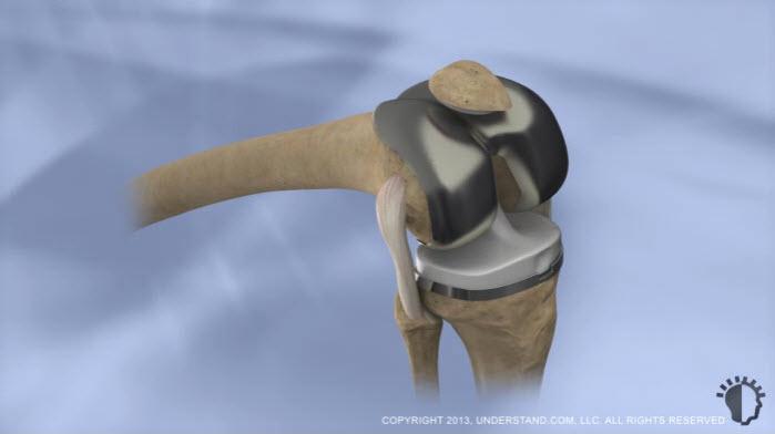 End of Procedure For tibial components that involve a stem, the channel in which the stem inserts into the tibia is now created.