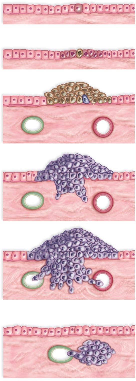 Cancer Development a. Cell (dark pink) acquires a mutation for repeated cell division. epithelial cells 1 mutation b. New mutations arise, and one cell (brown) has the ability to start a tumor.
