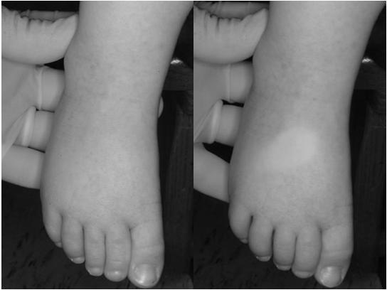 3 Year Old Male Presents with acute onset of fever with a light red rash that is covered with fine papules.