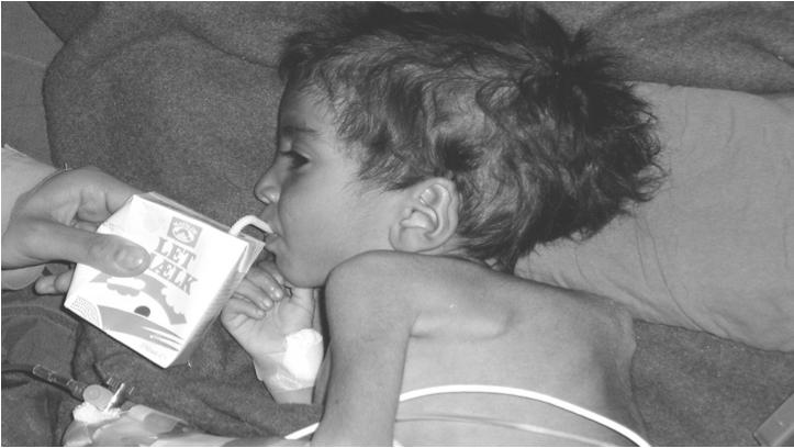 3-year-old female is dropped off in a sack at a U.S. Army Battalion Aid Station in Afghanistan. Found to be malnourished, with respiratory distress and a back deformity.