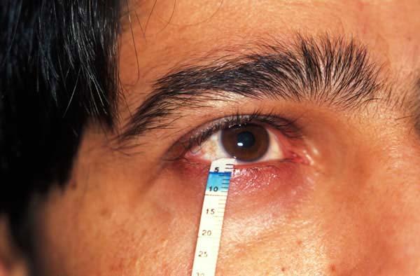 Dry Eye Basic secretor testing Consider modifying surgical