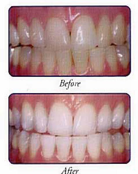 3. Teeth Whitening : - food, cigarette smoke, coffee, etc. form another layer gradually on top of the enamel layer.