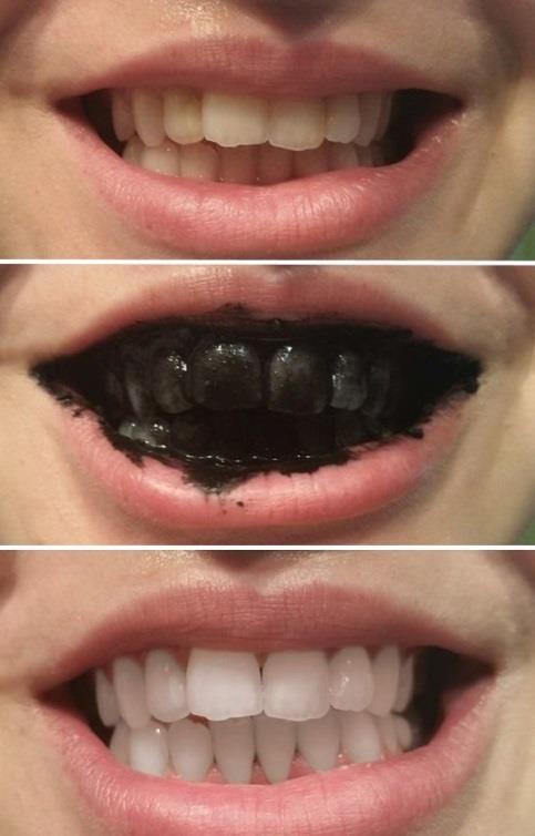Smile!! Take before and after pictures (no matter how awkward or embarrassed you feel doing it). This is the best way to record your whitening progress.