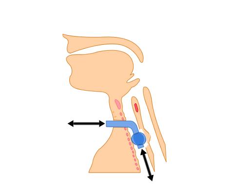 The image below shows an inflated tracheostomy tube. The cuff is pressing on the oesophagus behind the trachea, offering a physical obstruction to swallowing.
