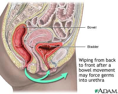 Cystitis disease usually cause voiding dysfunction The most common form of infection found in female.