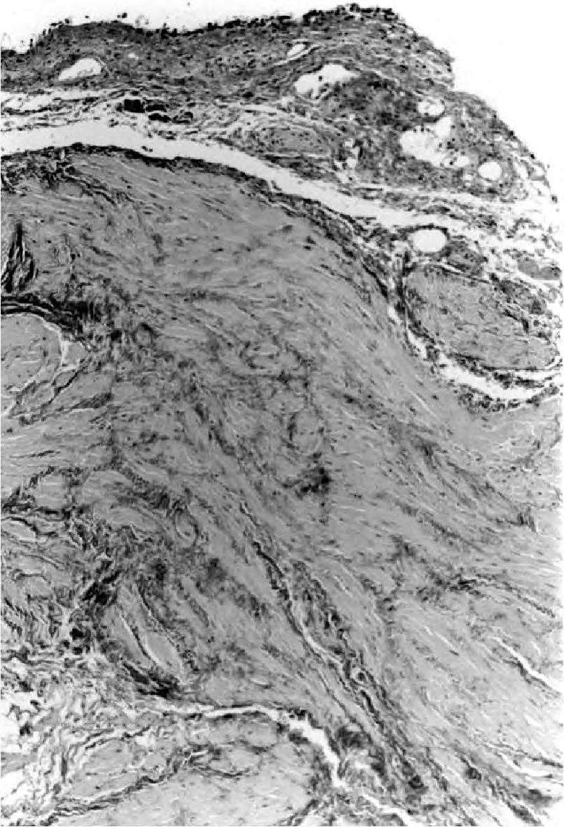 (Magnification 400x, AZAN staining) Figure 2 Intrafascicular elastosis of the bladder