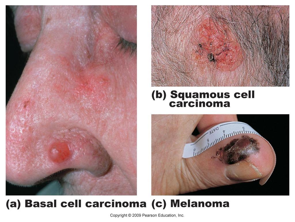 Melanoma Involves Highly metasta=c and resistant to chemotherapy Treated by wide surgical excision accompanied by Melanoma Characteris=cs ( rule) A: Asymmetry; the two sides of the pigmented area do
