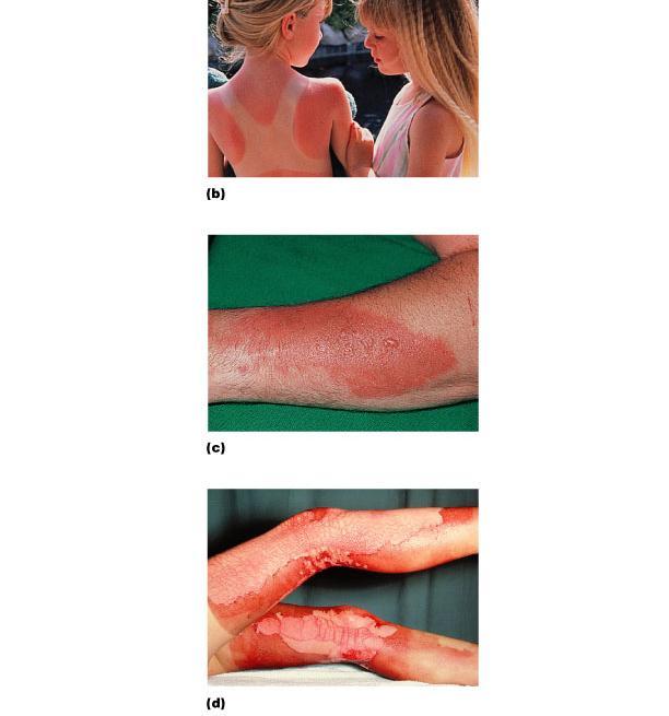 Burns First-degree (epidermis only; redness) Second-degree (epidermis and dermis, with