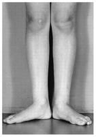 Understanding Your s Bowlegs & Knock-Knees What is Out-Toeing? Out-toeing or duck feet is much less common than in-toeing in children.