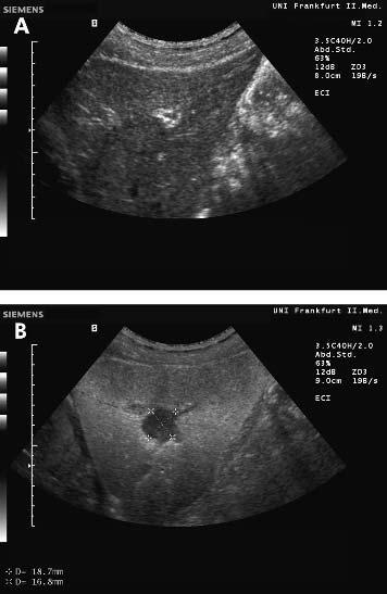 Characterisation of histologically proven liver tumours 403 Contrast enhanced US in the Levovist portal venous and late phase In all 79 patients with malignant liver lesions, hypoechoic contrast
